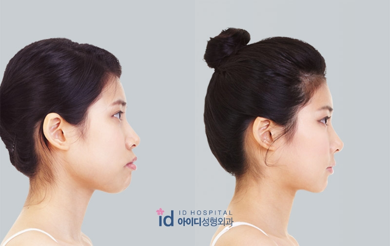 ID Hospital Korea Mouth protrusion treatment, it is essential to