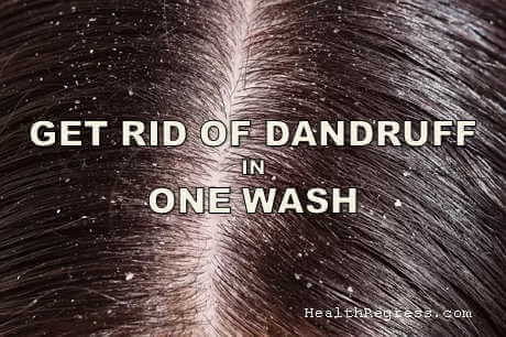 Remove Dandruff in One Wash How to Get Rid of Dandruff in One Wash