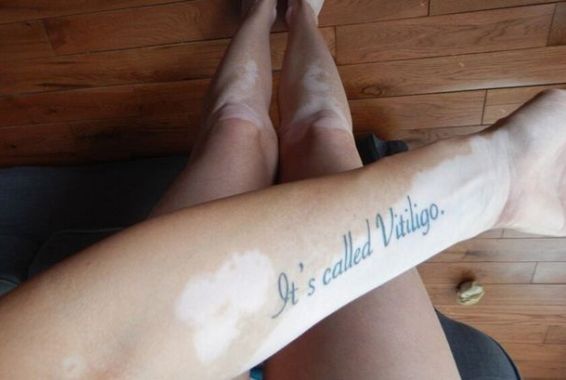 Woman with Vitiligo tired of stares gets perfect Tattoo response!