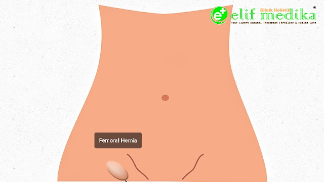 Hernia Femoralis Hernia Femoralis
