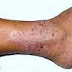 Obat Eksim Natural thumbnail