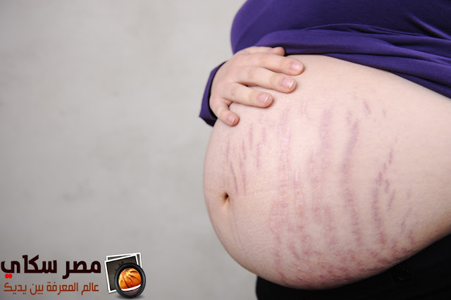 مشكلة زيادة الوزن والخطوط والتشققات فى البطن أثناء الحمل overweight