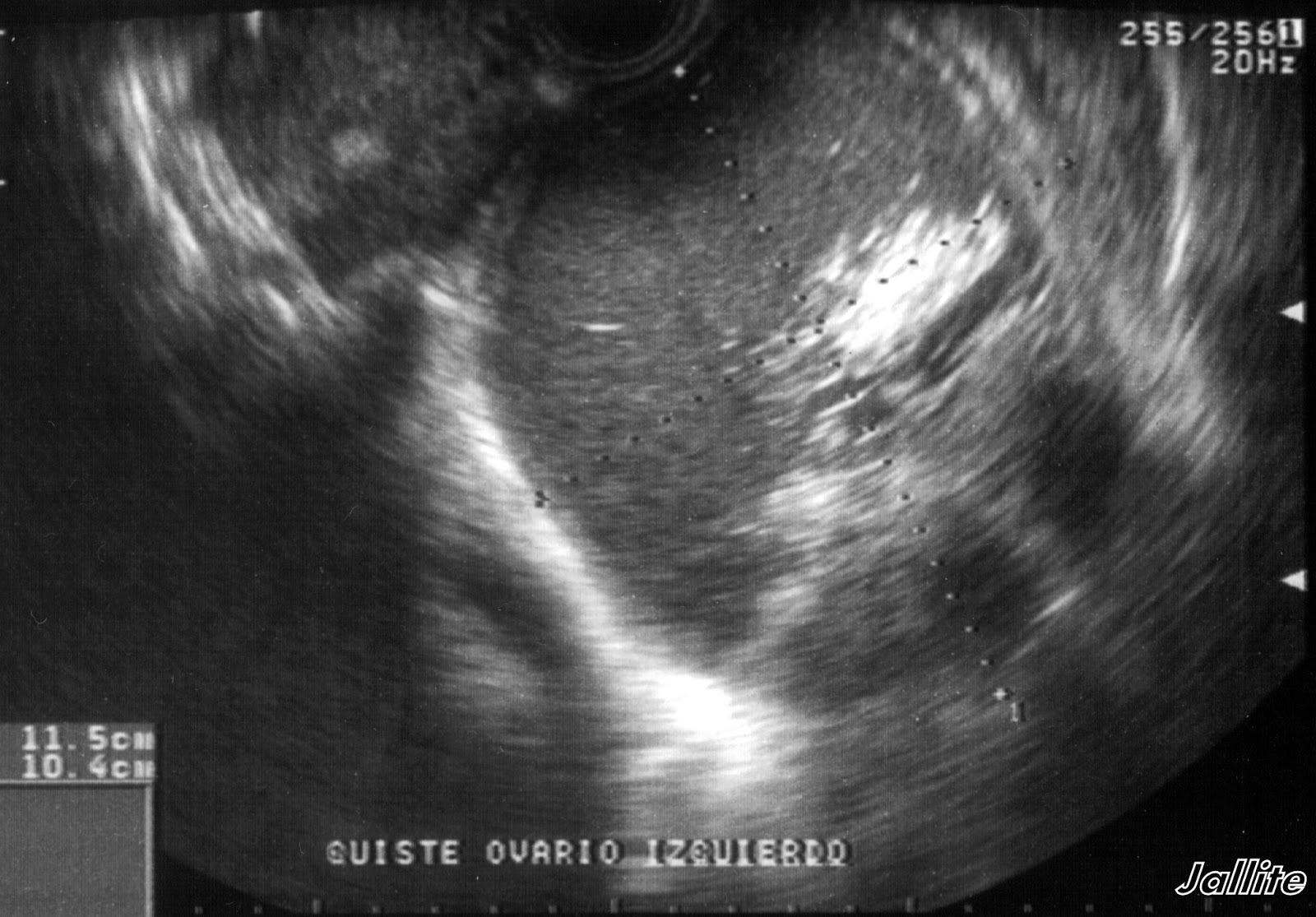 Quiste Ovario Complejo 4158 The Best Porn Website