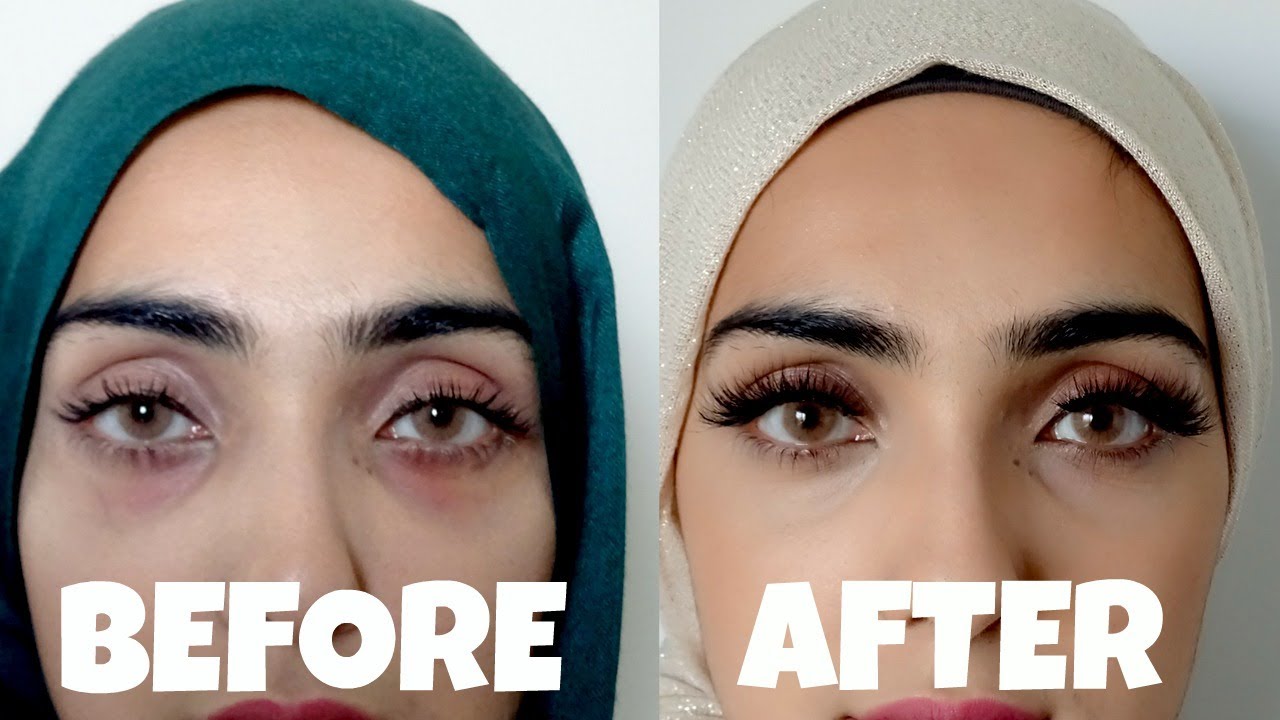 How to remove dark circles in few days healthvan