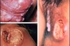 Sipilis
