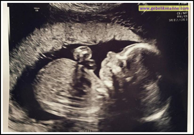 20 Haftalık Gebelik (Hamilelik) Ultrason Görüntüleri