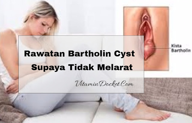  rawatan bartholin cyst