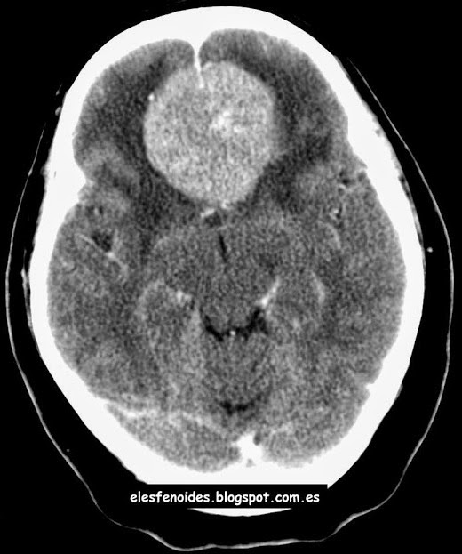 Meningioma de la hoz