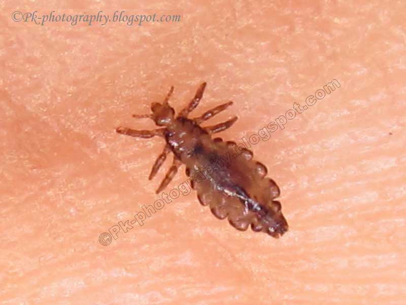 Head Lice Pictures 83