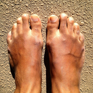 tieks bunions