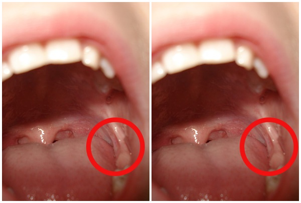 Contoh Gigi Bungsu yang Tumbuh Tidak Normal