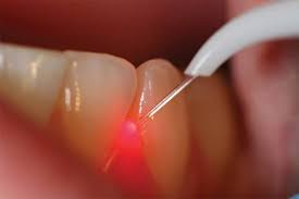 Kĩ thuật hàn răng Composite ĐẢM BẢO an toàn uy tín chất lượng cao