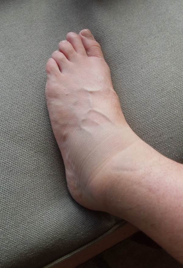 Swollen Ankles
