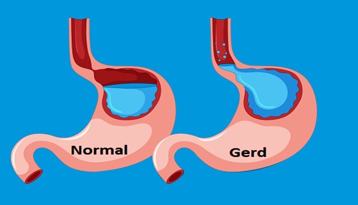 gambar penyakit gerd asam lambung tinggi gambar penyakit gerd asam lambung tinggi