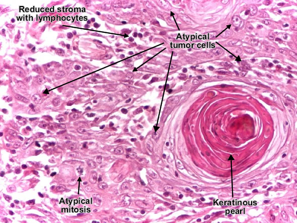موقع الدكتور أحمد كلحى: صور باثولوجى -- ﻿Patholgy Slides : Tumors or