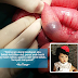 Anak Kecil Hampir Dibuang Usus Kerana Tertelan 'Baby Crystal'