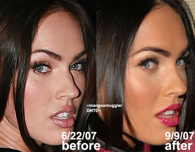 Celebrity Nose Jobs Before and After