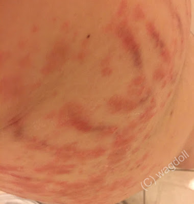 puppps rash on back