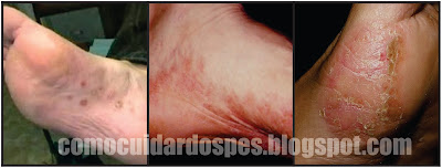Disidrose nos Pés - eczema disidrotico