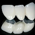 Răng sứ titan - Nhiều ưu điểm vượt trội
