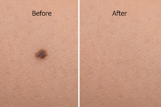 Facial Exercises mole on woman skin before after laser treatment