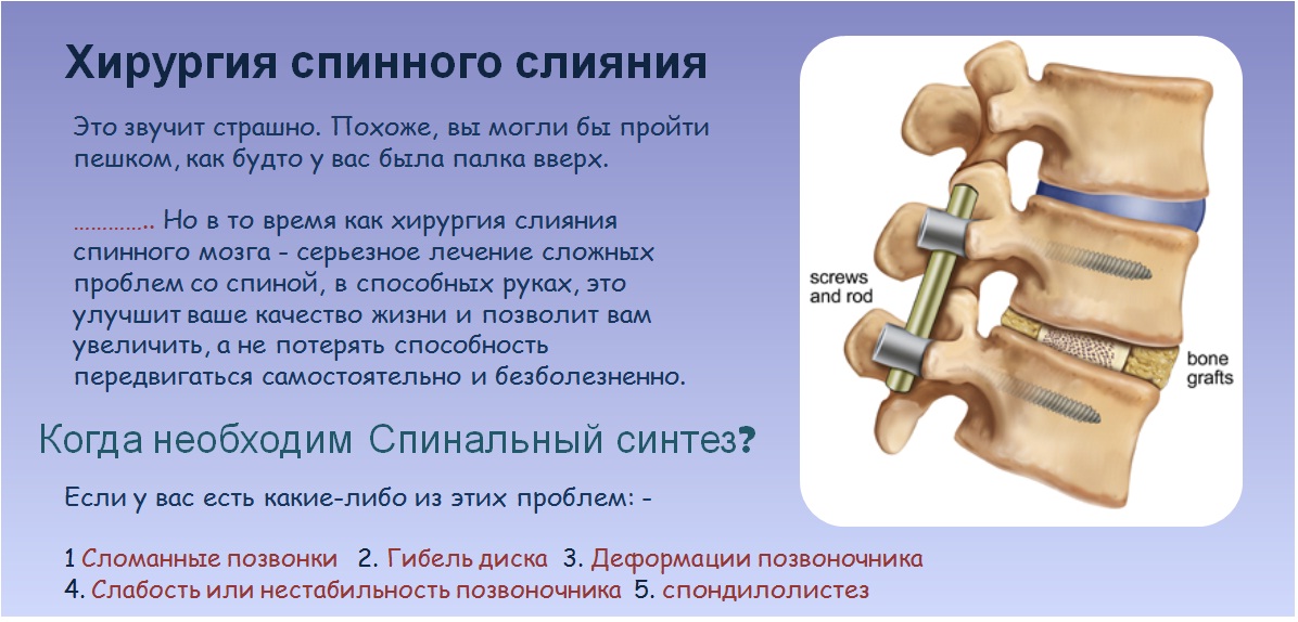 Спондилолистез пояснично-крестцового. Нестабильность сегментов позвоночника. Нестабильность сегментов позвоночника. Передний и задний спондилодез. Нестабильность шейного отдела с1 с2.