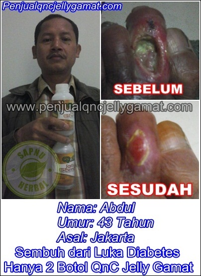 Obat Luka Borok Bernanah Dan Berair, Menyembuhkan Luka Borok Bernanah dan Berair Sampai Sembuh Total Obat Luka Borok Bernanah Dan Berair, Menyembuhkan Luka Borok Bernanah dan Berair Sampai Sembuh Total