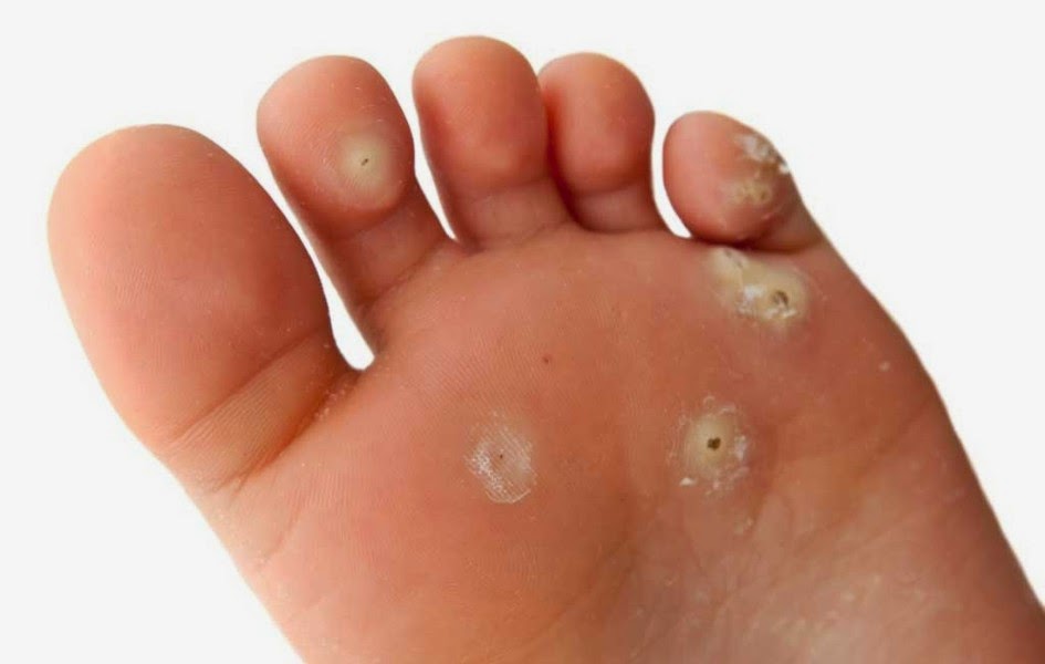 What Causes Common Warts? Viruses and Skin Warts - WebMD