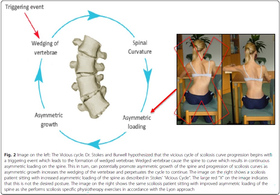 fisioterapia #traumatoortopedia #exercíciosterapêuticos #escoliose