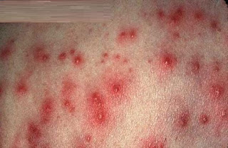 Foto Gejala, Penyebab Serta : Obat Herpes Penyakit Kelamin Paling Ampuh