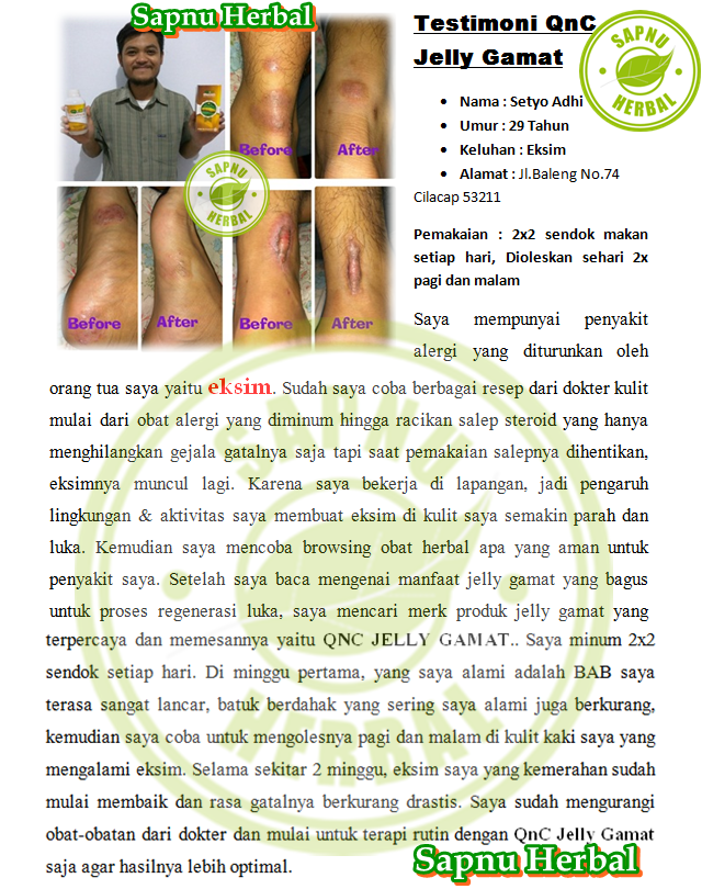 Cara Ampuh Mengobati Impetigo Secara Total Cara Ampuh Mengobati Impetigo Secara Total