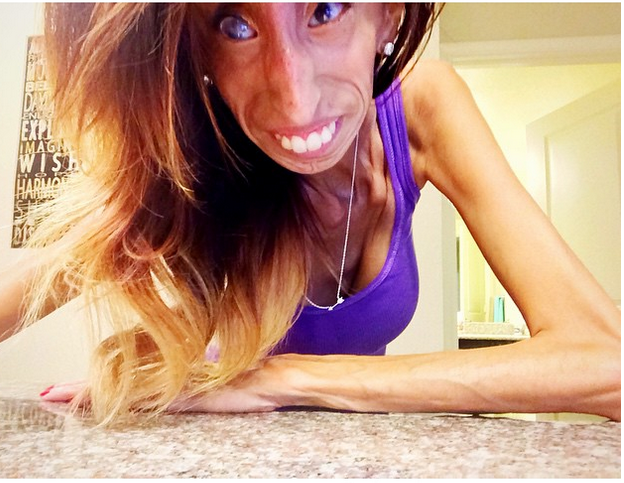 Health Disease And Treatment Lizzie Velasquez Stands Against Bullying On YouTube