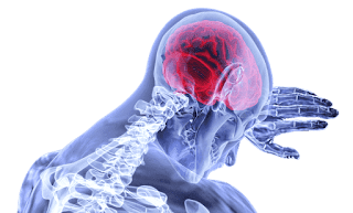 Brain Stroke, Types of, Symptoms, and Treatment. Brain Stroke, Types of, Symptoms, and Treatment.
