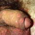 Pengobatan Luka Lecet Di Batang Penis Secara Alami