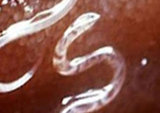 كيف تقتل الديدان في بطنك وتطردها