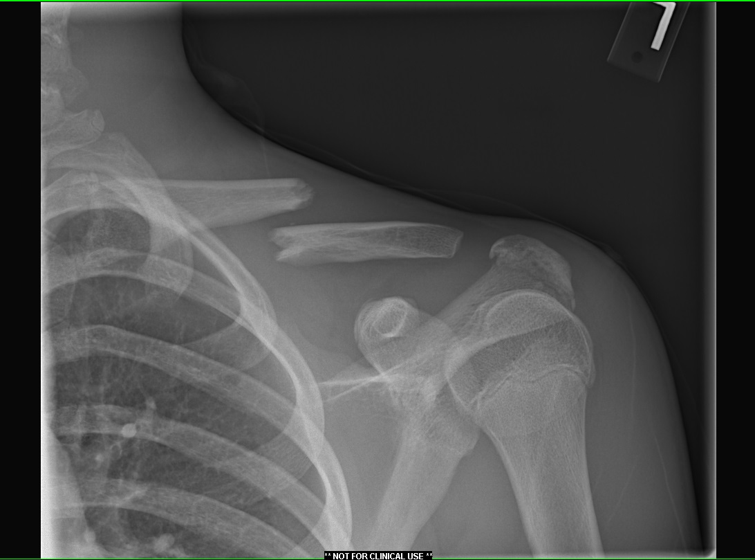 clavicle bone fracture