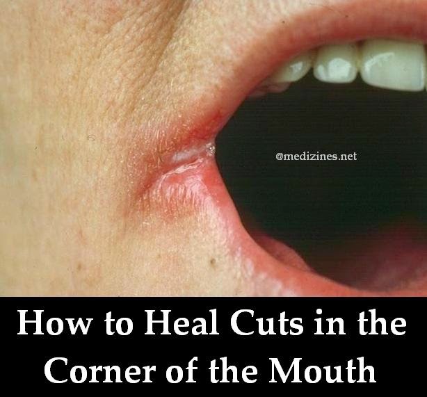 Cuts Corner Of Mouth 57
