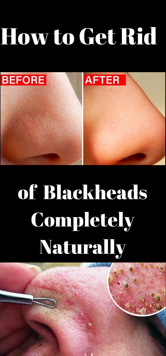 How to Get Rid of Blackheads Completely Naturally