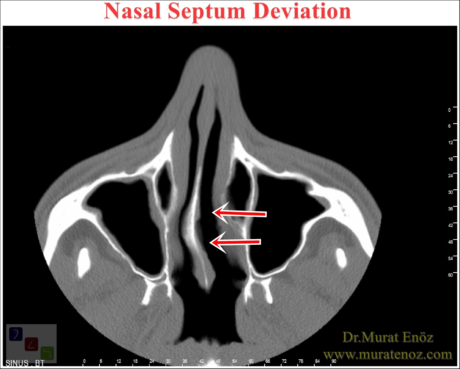 How Can You Understand That "Nasal Septum Deviation" Is In Your Nose?
