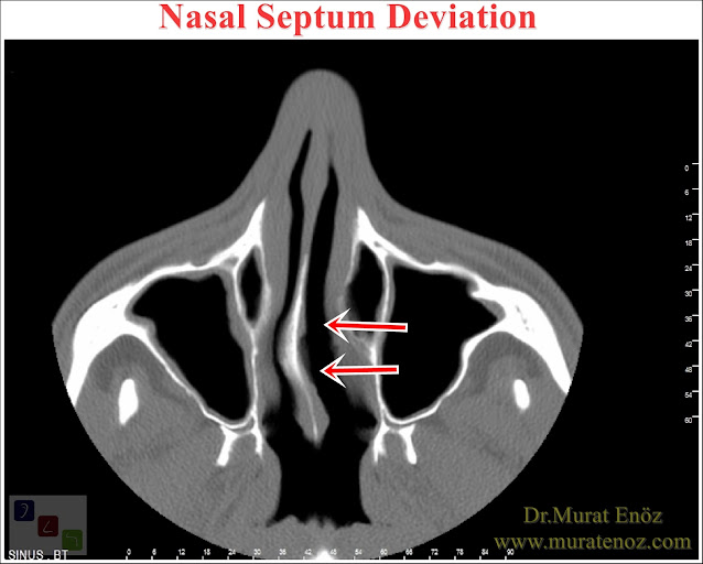 How Can You Understand That "Nasal Septum Deviation" Is In Your Nose?