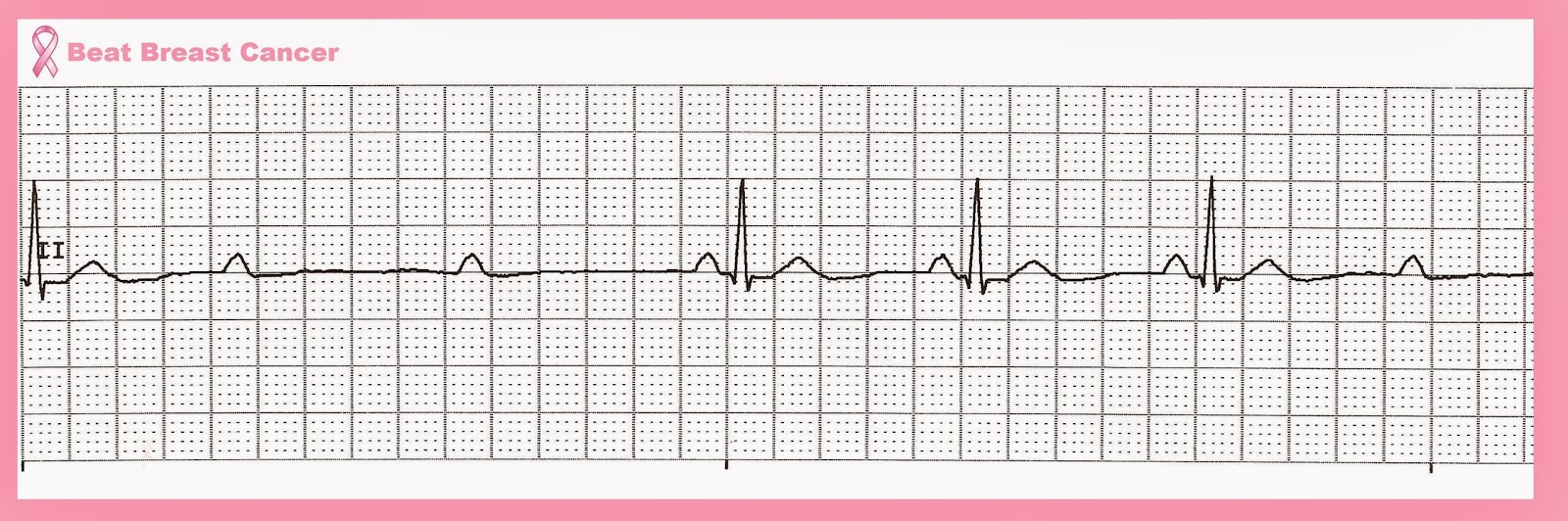 Float Nurse: Practice EKG Strips 357