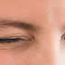 Herble Eye Twiching Treatment at Home - Get Rid Of Eye Twitching