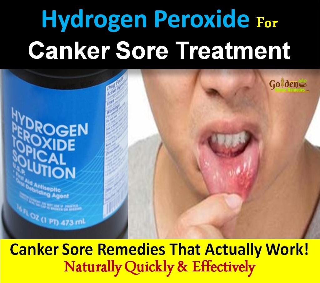 How To Cure Cold Sores Naturally How To Cure Cold Sores Naturally