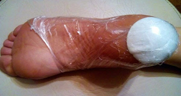 σκασμένες φτέρνες