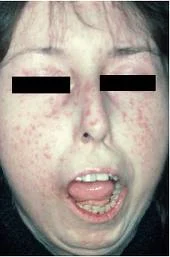 scleroderma-face