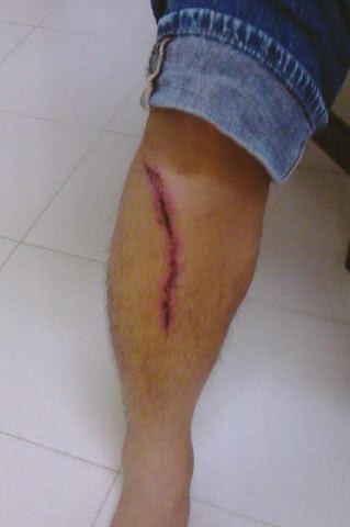 Injuries Are Sexy