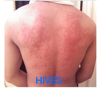 5 Exemption of hives will not expect you
