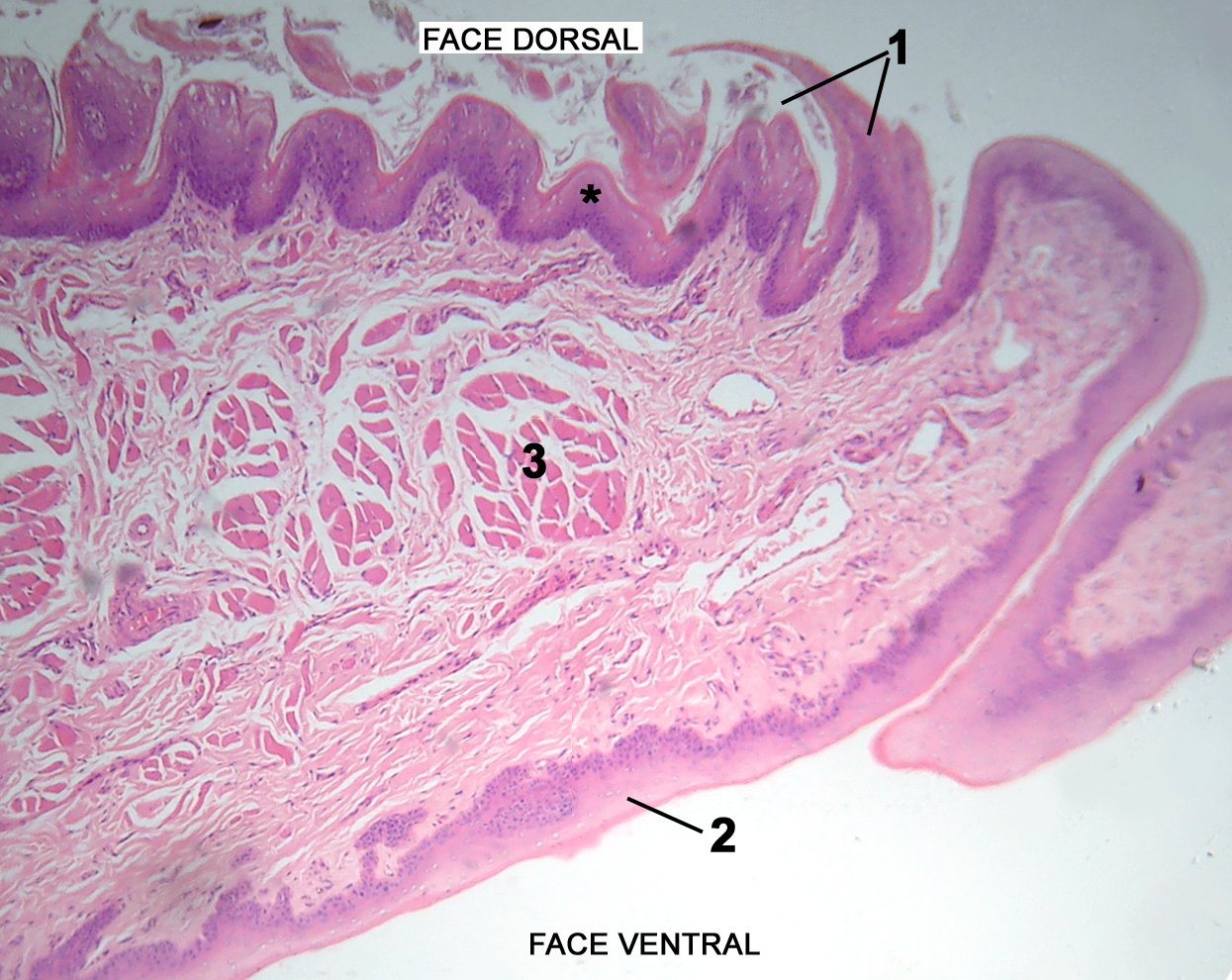 papiloma lingual histologia