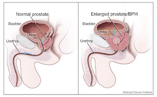 Prostate Cancer: Symptoms, Diagnosis, Prevention, Gay prostate cancer