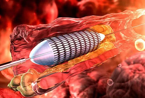 angioplasty jantung perawatan penyakit jantung angioplasty